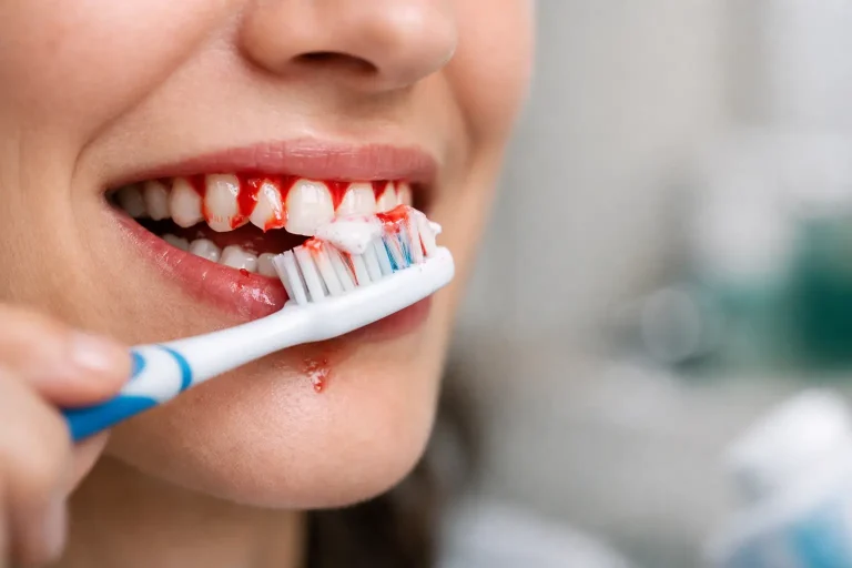 Read more about the article Why Do Gums Bleed Brushing?